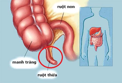 sau-khi-mo-ruot-thua-nen-va-khong-nen-an-gi