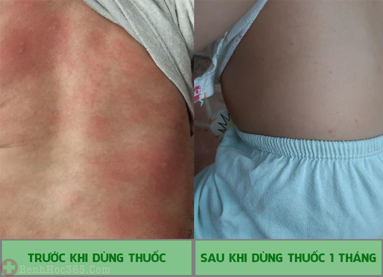  Thuốc chữa mề đay mẩn ngứa của Trung tâm Thuốc dân tộc