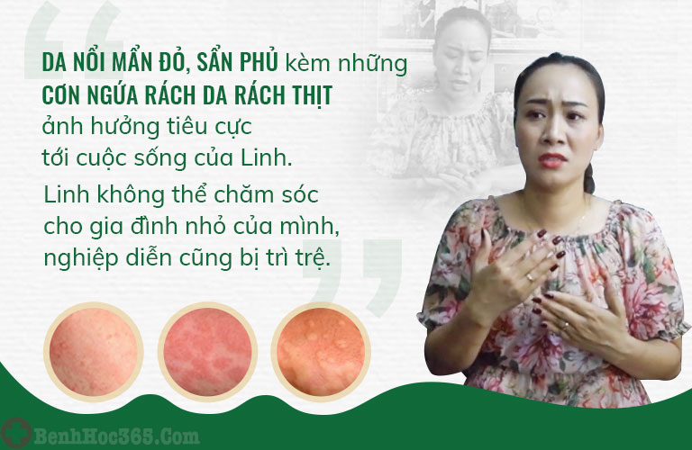 Chị Linh bị ám ảnh mỗi lần nhớ lại triệu chứng của mề đay gây ra