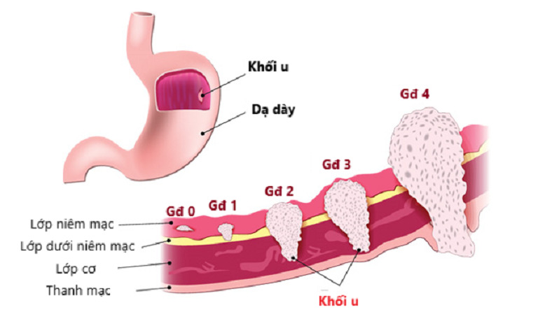 Các giai đoạn phát triển của ung thư bao tử