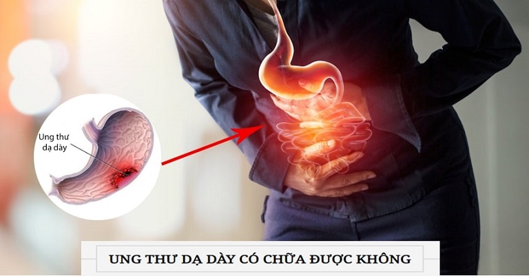 Ung thư bao tử có thể chữa được không?