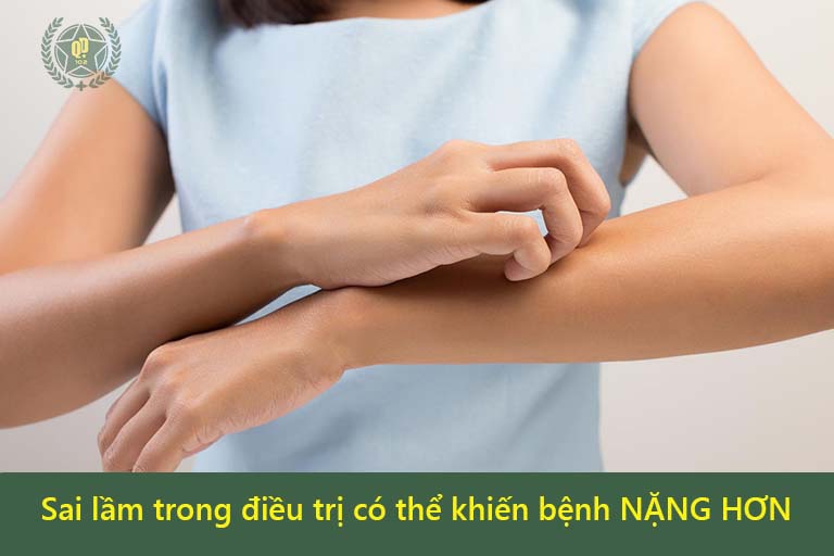 Sai lầm trong điều trị viêm da cơ địa sẽ khiến bệnh nặng hơn