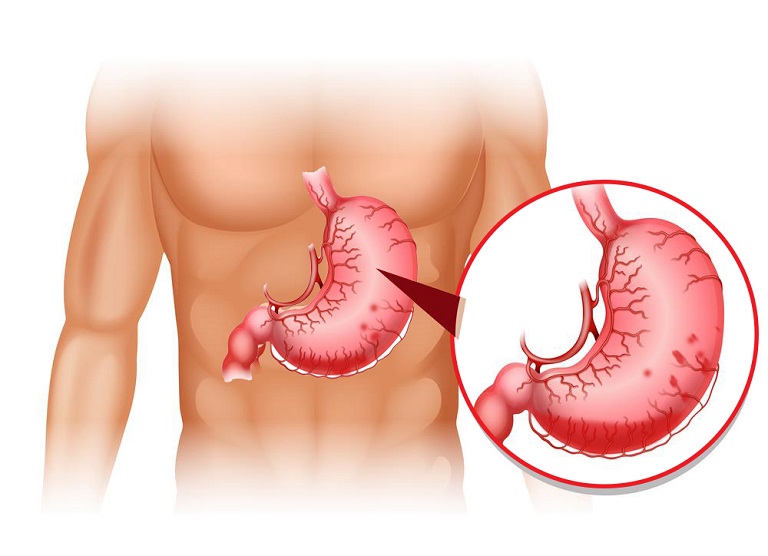 Đau dạ dày trong đêm có thể gây xuất huyết tiêu hóa nếu không được điều trị kịp thời