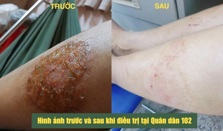 Hình ảnh vùng da bị tổn thương của chị Ngọc trước và sau khi điều trị tại Quân dân 102