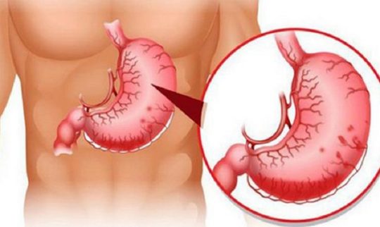 Nếu không được điều trị kịp thời, xuất huyết dạ dày có thể gây tử vong
